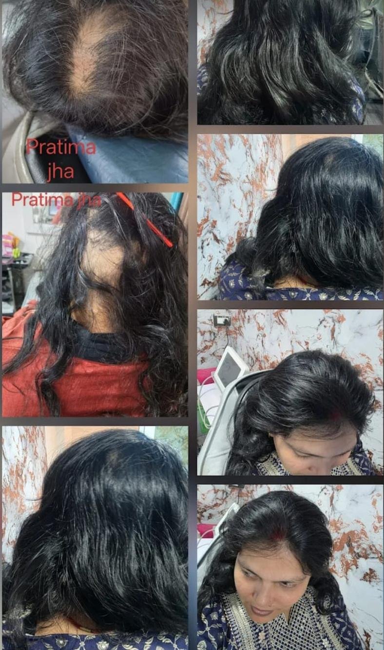 Alopecia Areata Treatment