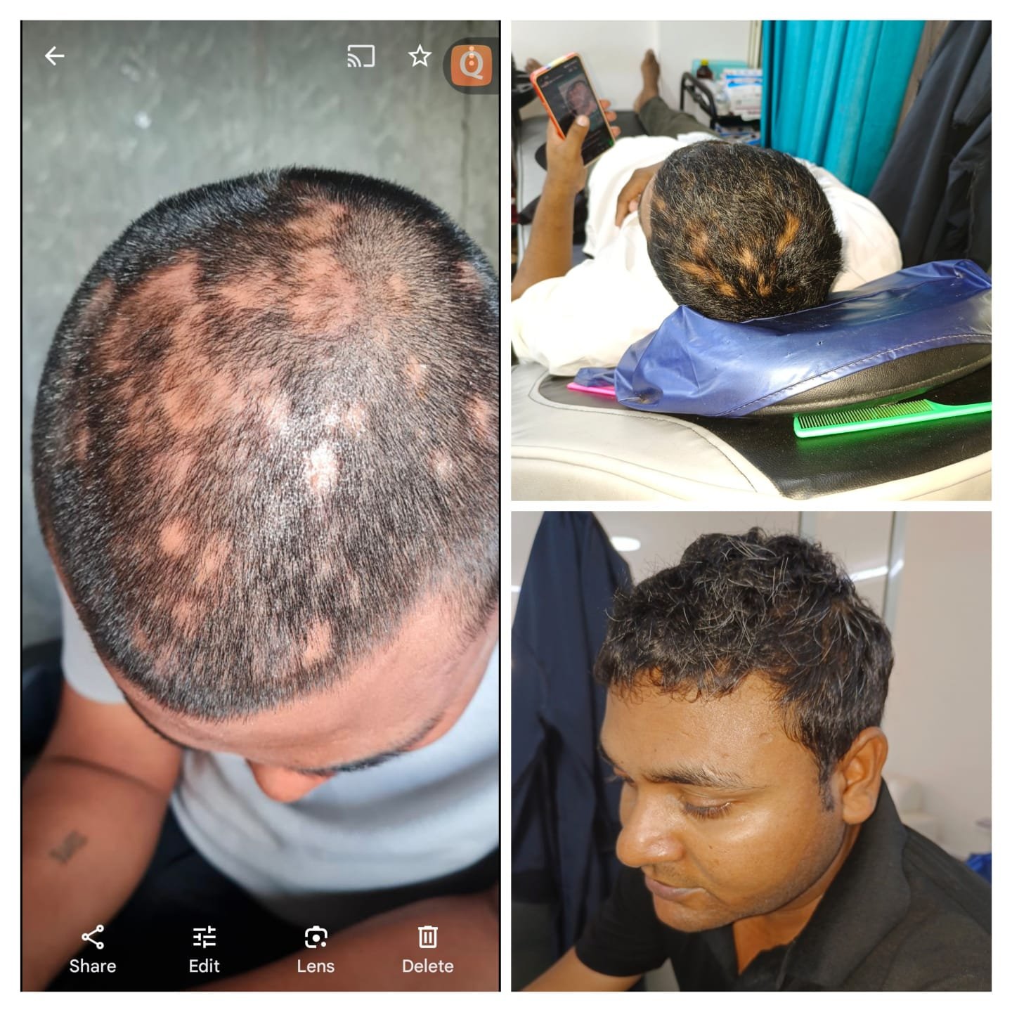 Alopecia Areata Treatment