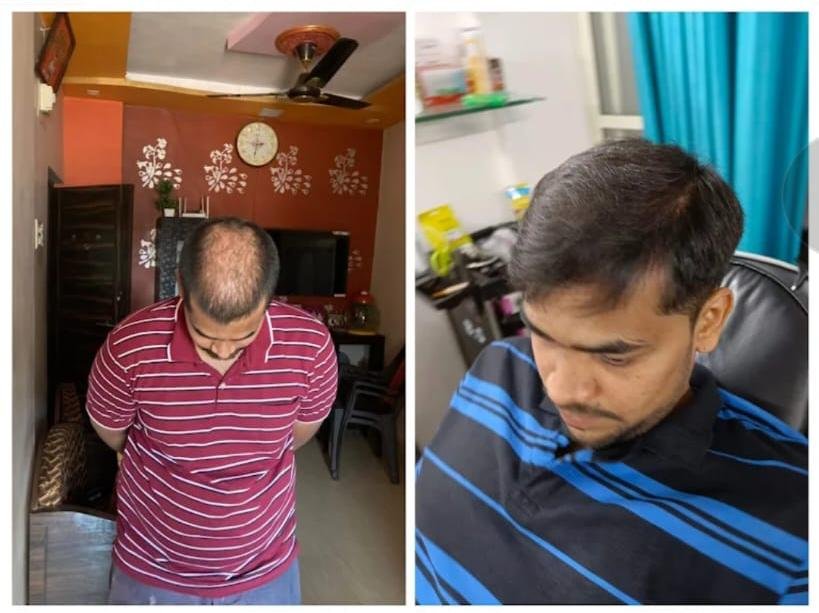 Alopecia Treatment