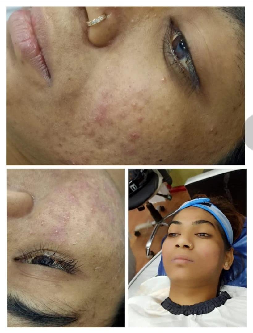 Acne Treatment